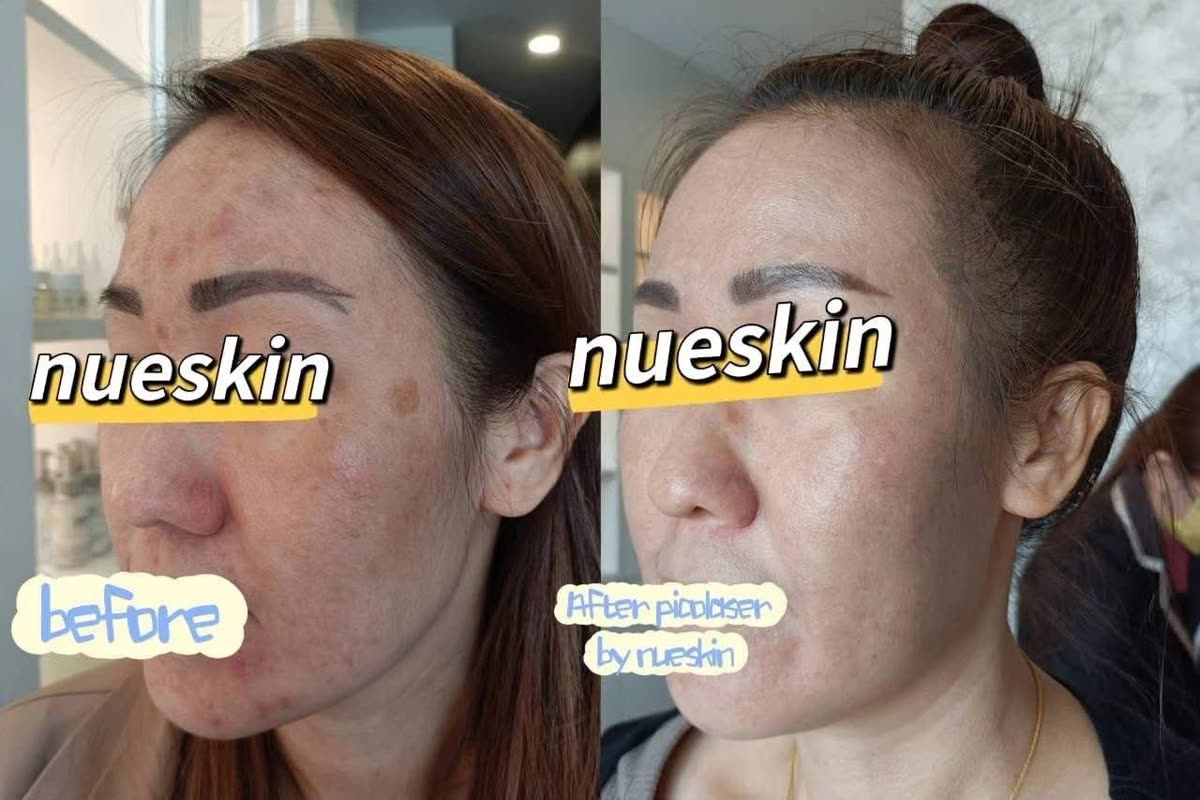 Client treatment result before and after — Nue Skin Beauty Esthetique