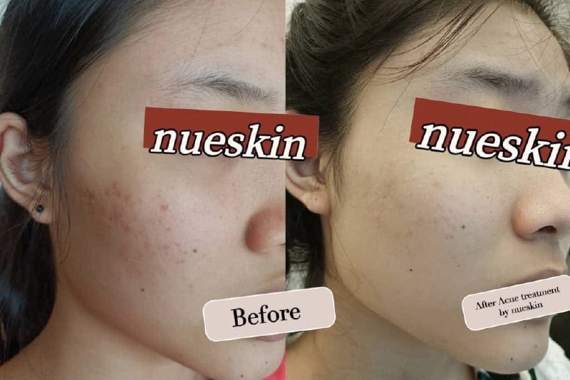 Client treatment result before and after — Nue Skin Beauty Esthetique