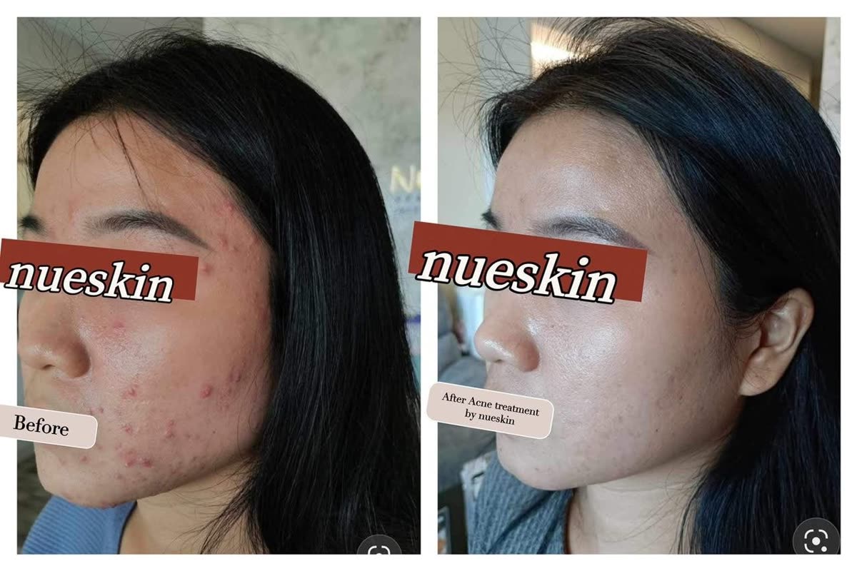 Client treatment result before and after — Nue Skin Beauty Esthetique