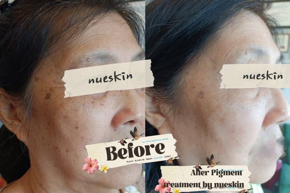 Client treatment result before and after — Nue Skin Beauty Esthetique