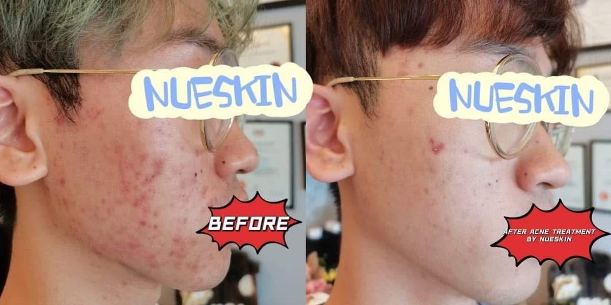 Client treatment result before and after — Nue Skin Beauty Esthetique