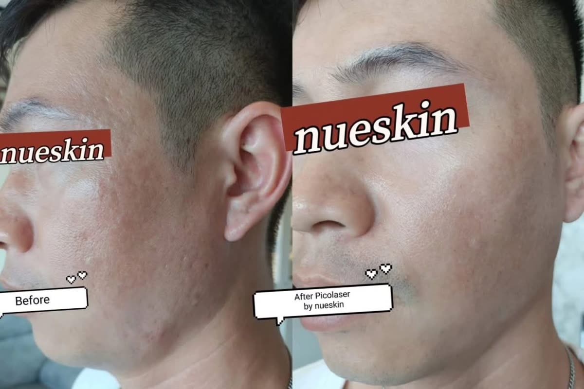 Client treatment result before and after — Nue Skin Beauty Esthetique