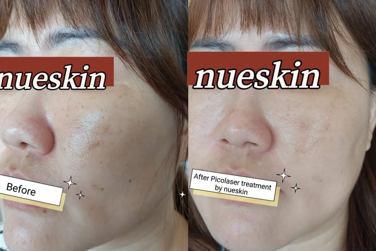 Client treatment result before and after — Nue Skin Beauty Esthetique