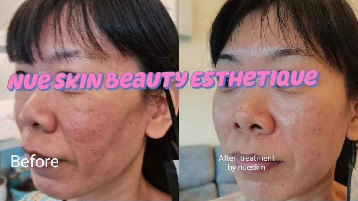 Client treatment result before and after — Nue Skin Beauty Esthetique