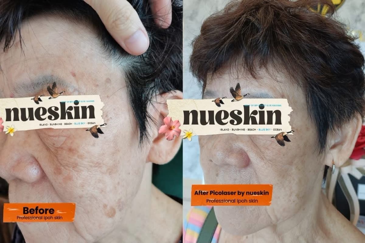 Client treatment result before and after — Nue Skin Beauty Esthetique