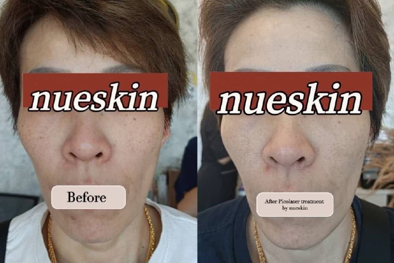 Client treatment result before and after — Nue Skin Beauty Esthetique
