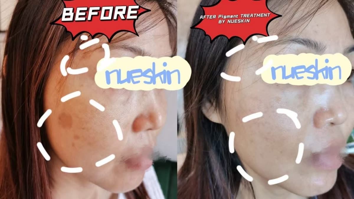 Client treatment result before and after — Nue Skin Beauty Esthetique