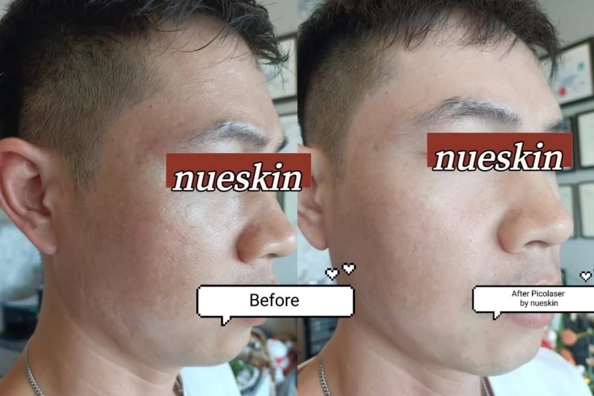 Client treatment result before and after — Nue Skin Beauty Esthetique
