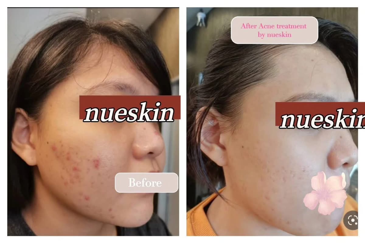 Client treatment result before and after — Nue Skin Beauty Esthetique