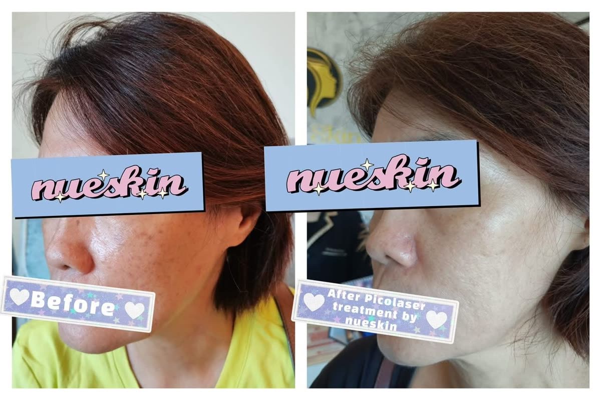 Client treatment result before and after — Nue Skin Beauty Esthetique