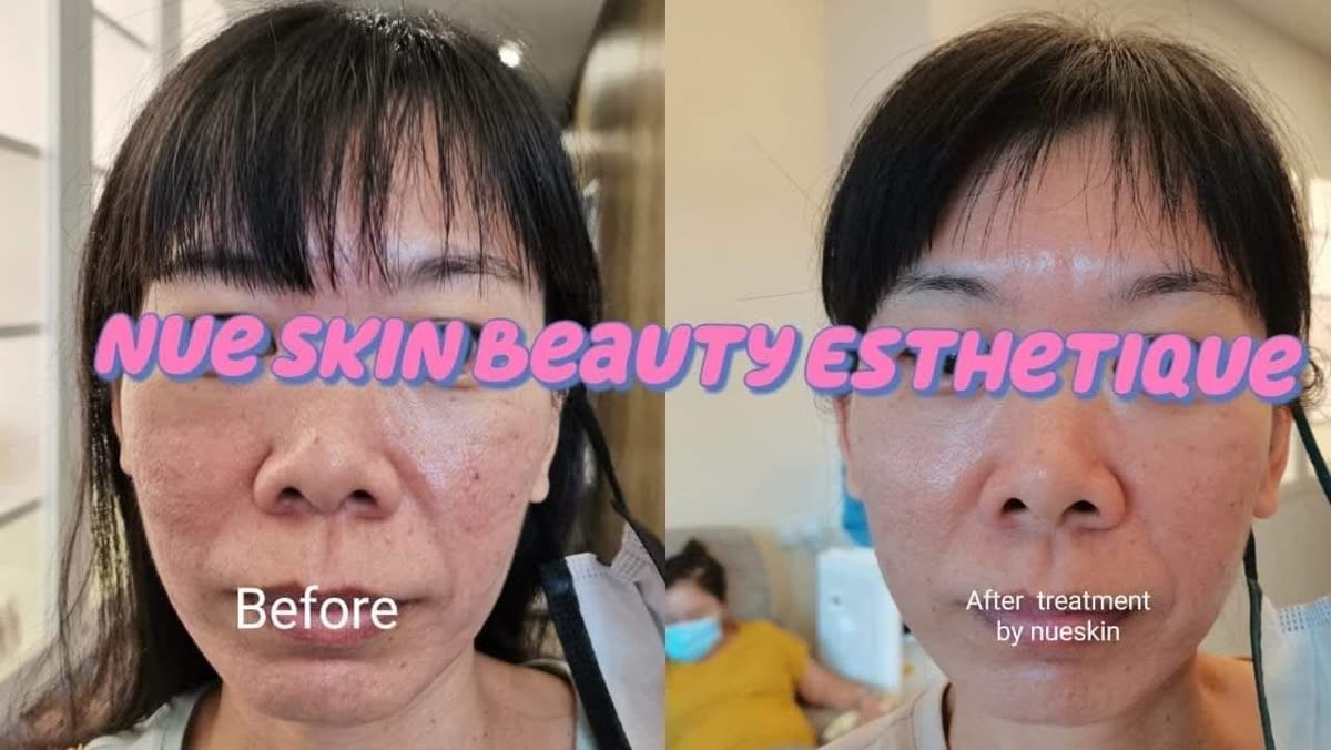 Client treatment result before and after — Nue Skin Beauty Esthetique