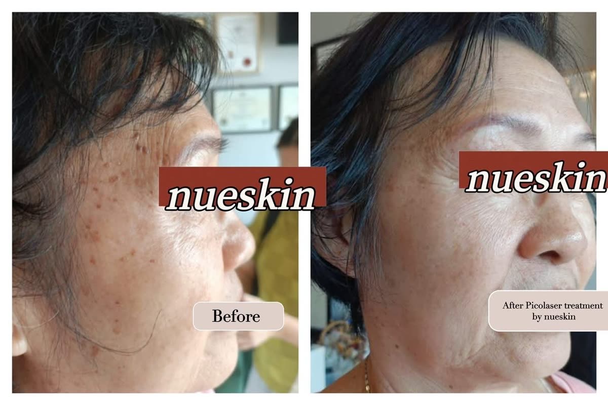 Client treatment result before and after — Nue Skin Beauty Esthetique