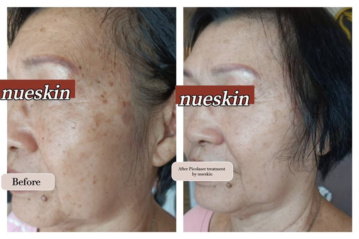 Client treatment result before and after — Nue Skin Beauty Esthetique