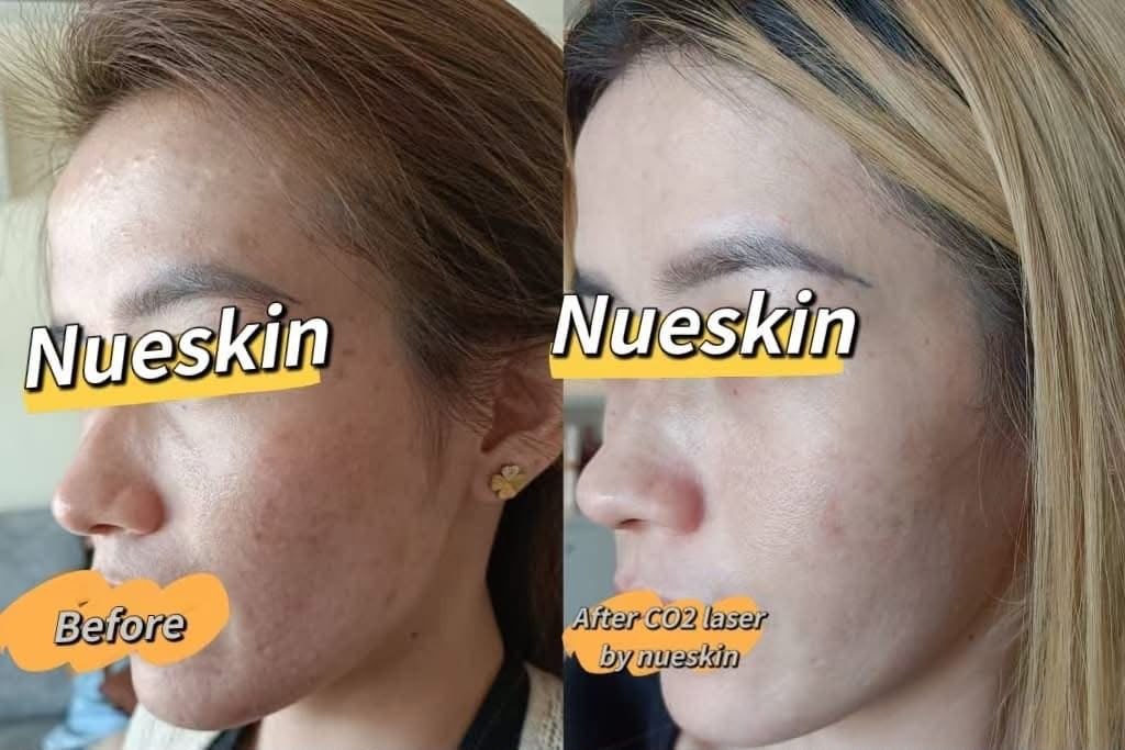 Client treatment result before and after — Nue Skin Beauty Esthetique