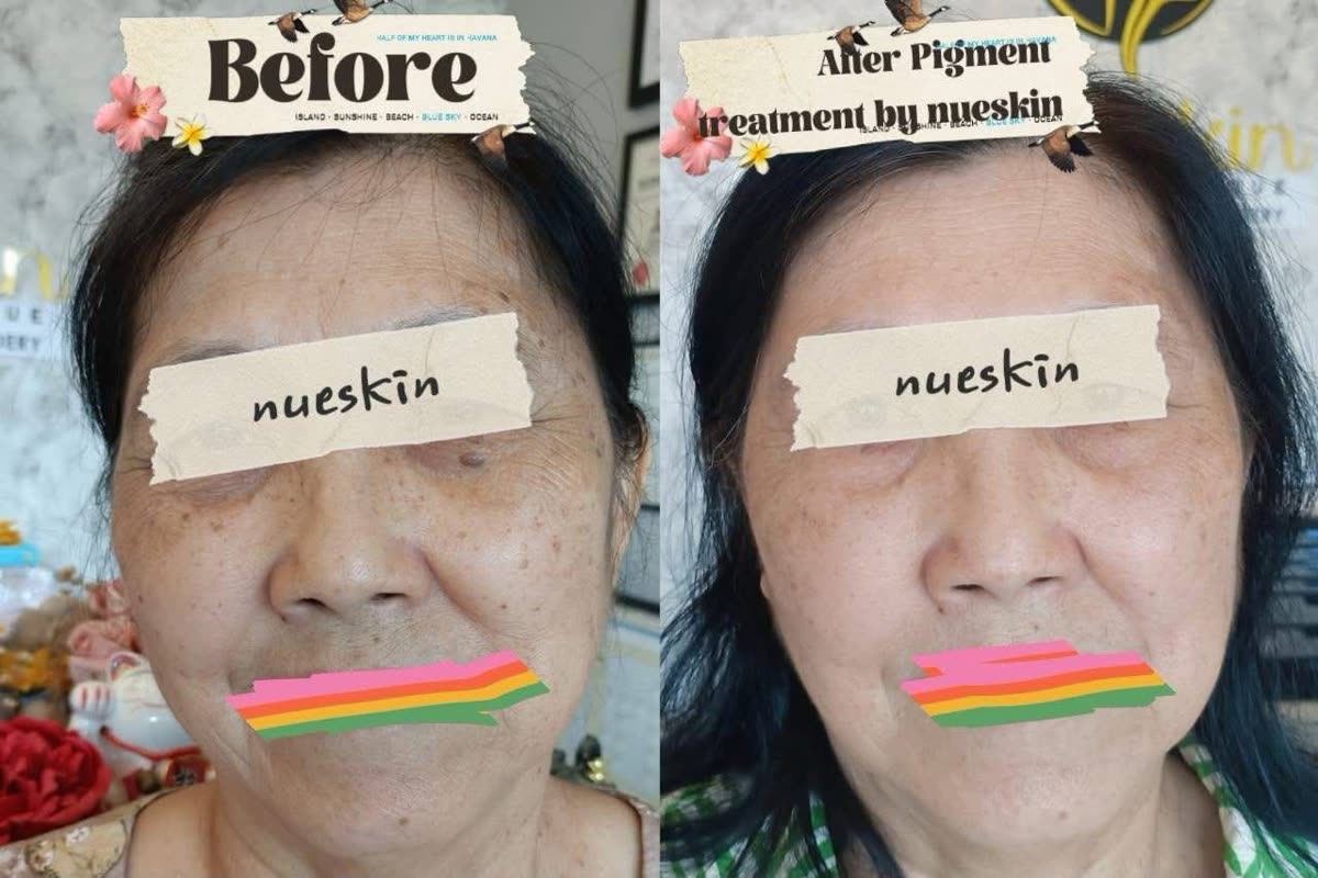 Client treatment result before and after — Nue Skin Beauty Esthetique