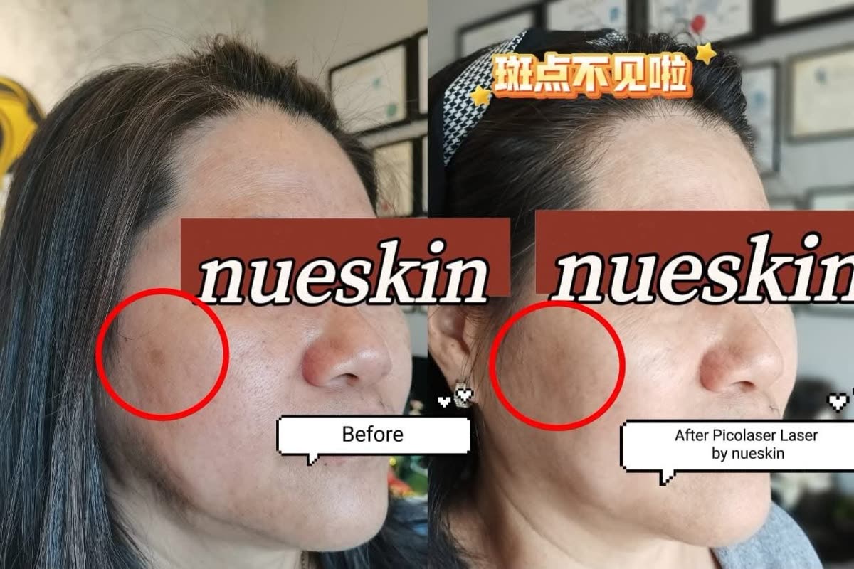 Client treatment result before and after — Nue Skin Beauty Esthetique