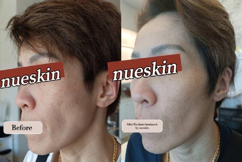 Client treatment result before and after — Nue Skin Beauty Esthetique