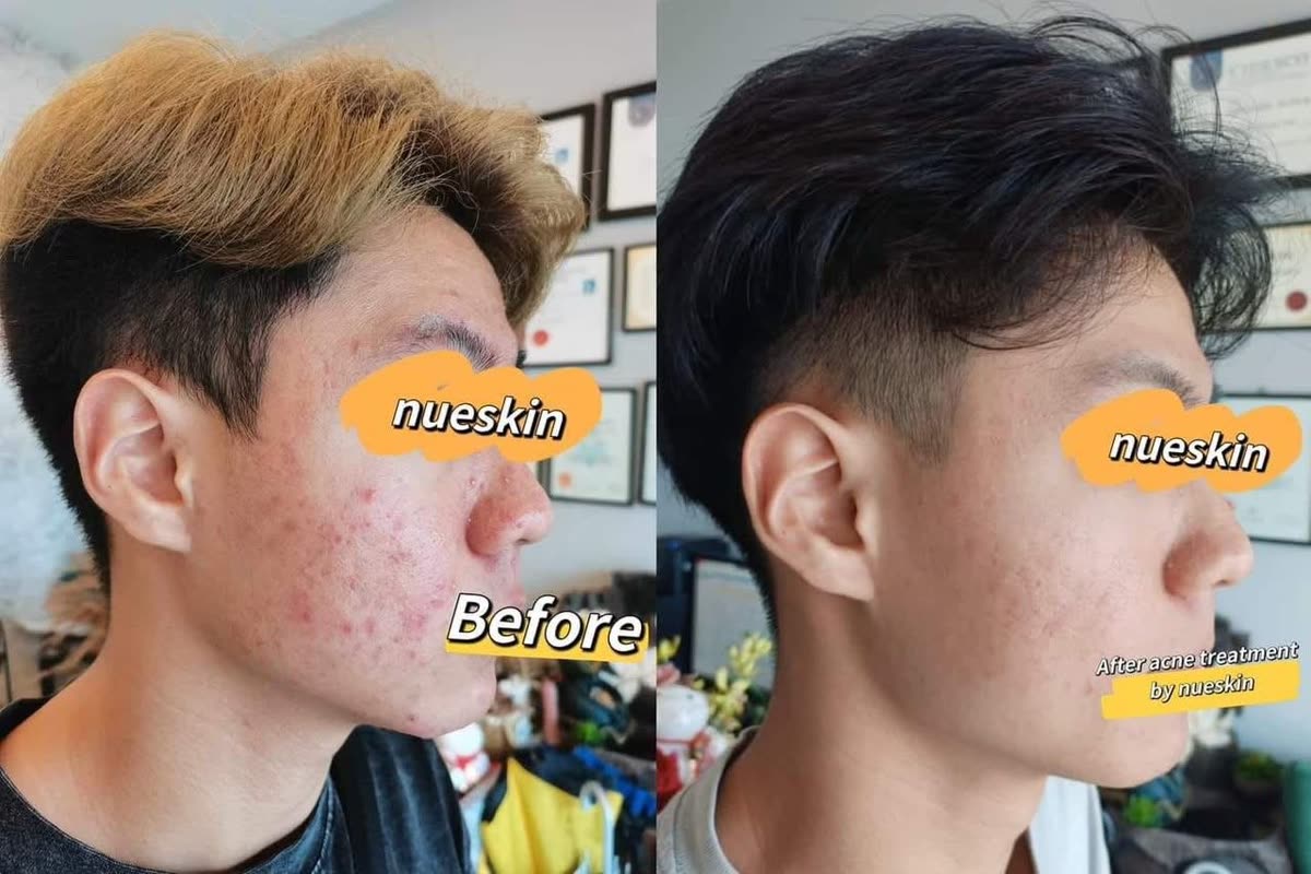 Client treatment result before and after — Nue Skin Beauty Esthetique