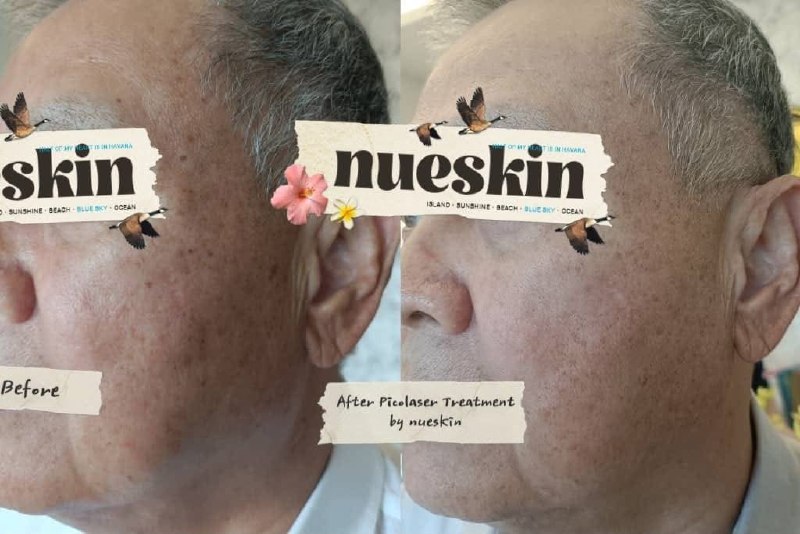 Client treatment result before and after — Nue Skin Beauty Esthetique