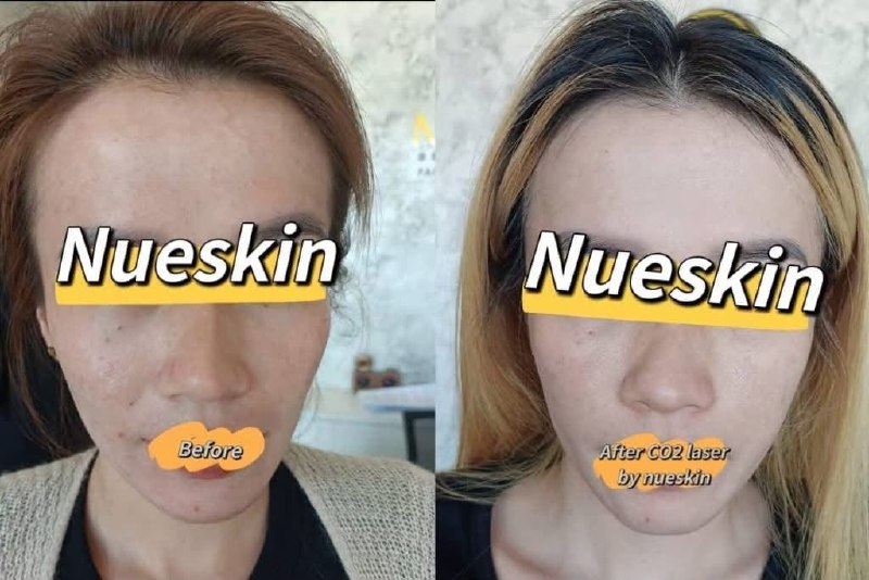 Client treatment result before and after — Nue Skin Beauty Esthetique