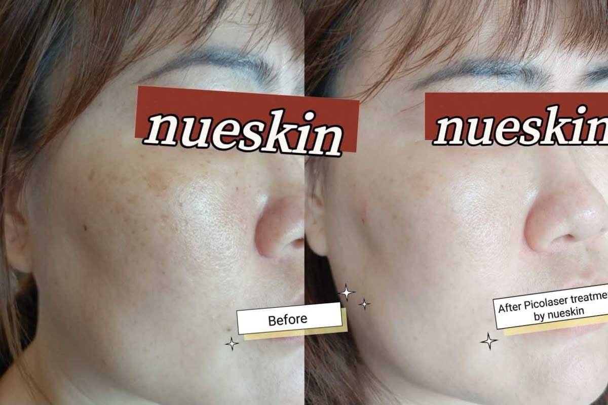 Client treatment result before and after — Nue Skin Beauty Esthetique