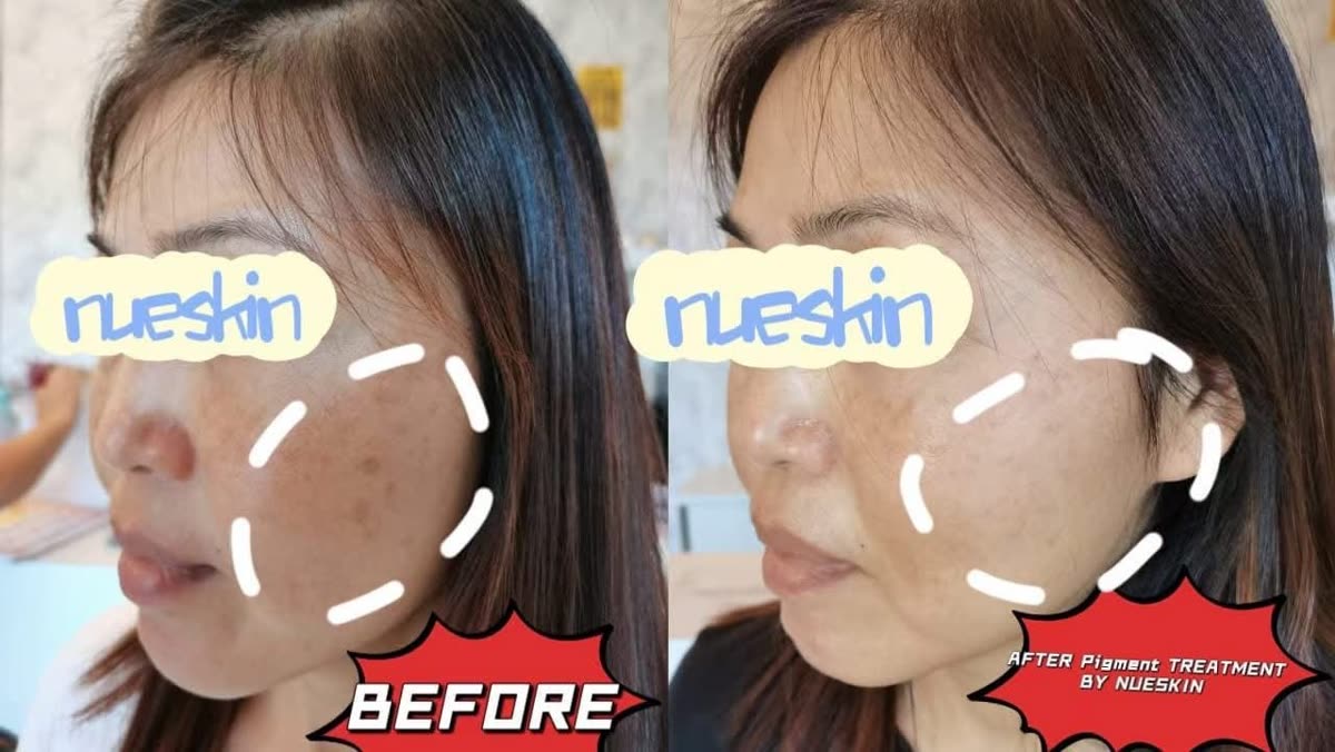 Client treatment result before and after — Nue Skin Beauty Esthetique