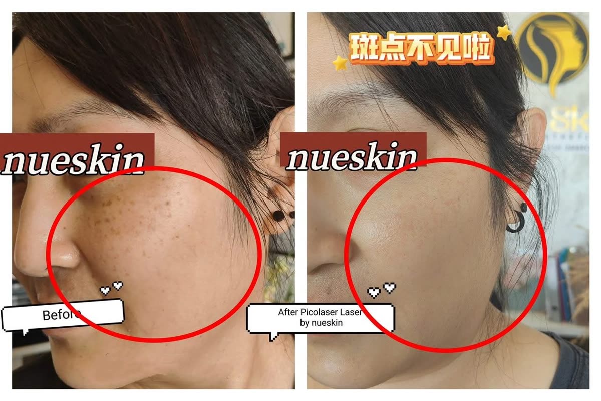 Client treatment result before and after — Nue Skin Beauty Esthetique