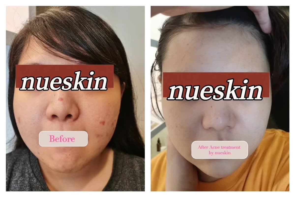 Client treatment result before and after — Nue Skin Beauty Esthetique