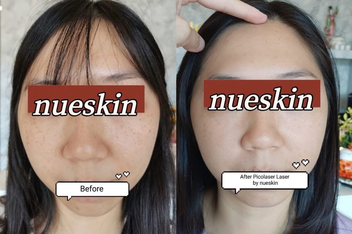 Client treatment result before and after — Nue Skin Beauty Esthetique