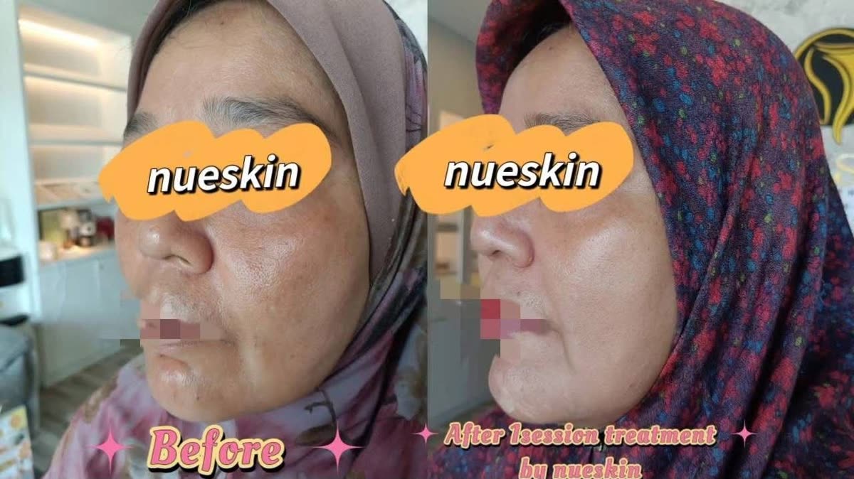 Client treatment result before and after — Nue Skin Beauty Esthetique
