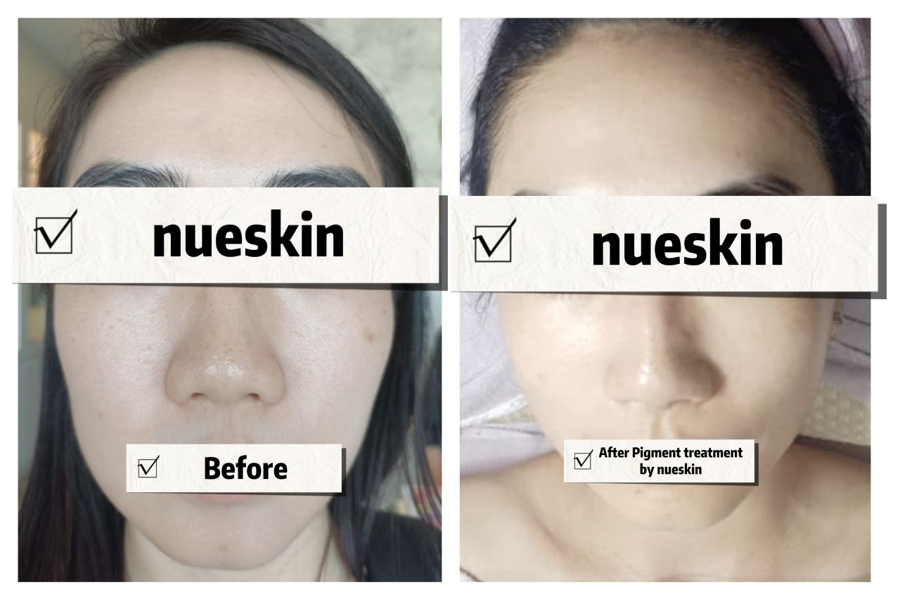 Facial treatment result with fresher clearer skin after one session — Nue Skin Beauty Esthetique