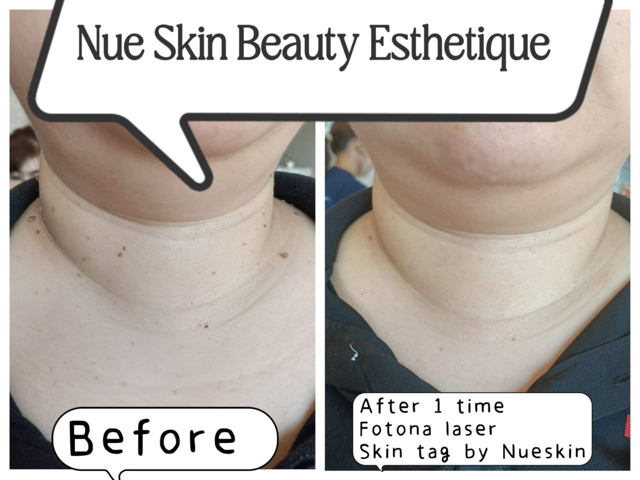 Fotona laser skin tag removal on neck after one session — Nue Skin Beauty Esthetique