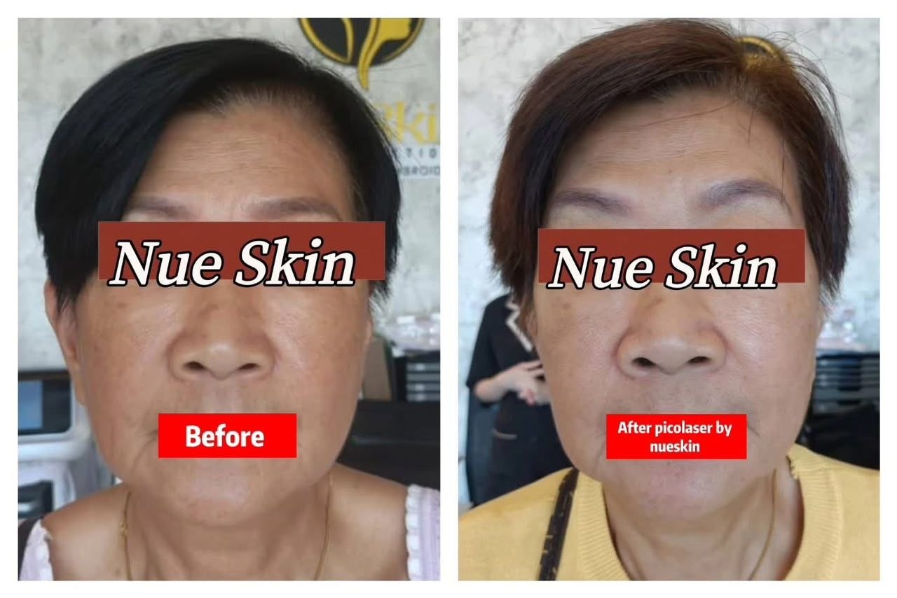 Picolaser Pigmentation Treatment before and after — Nue Skin Beauty Esthetique