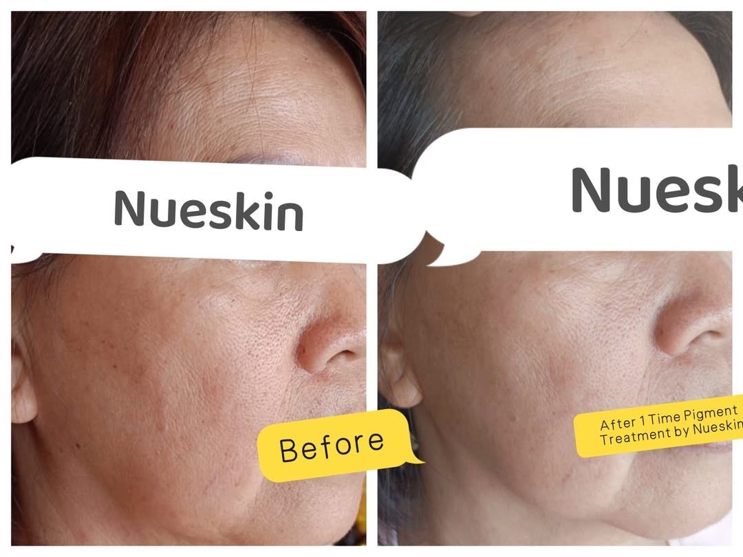 Pigment Treatment before and after — Nue Skin Beauty Esthetique