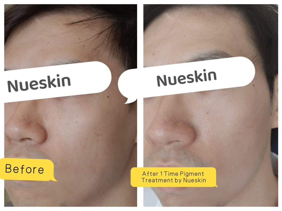 Pigment Treatment before and after — Nue Skin Beauty Esthetique