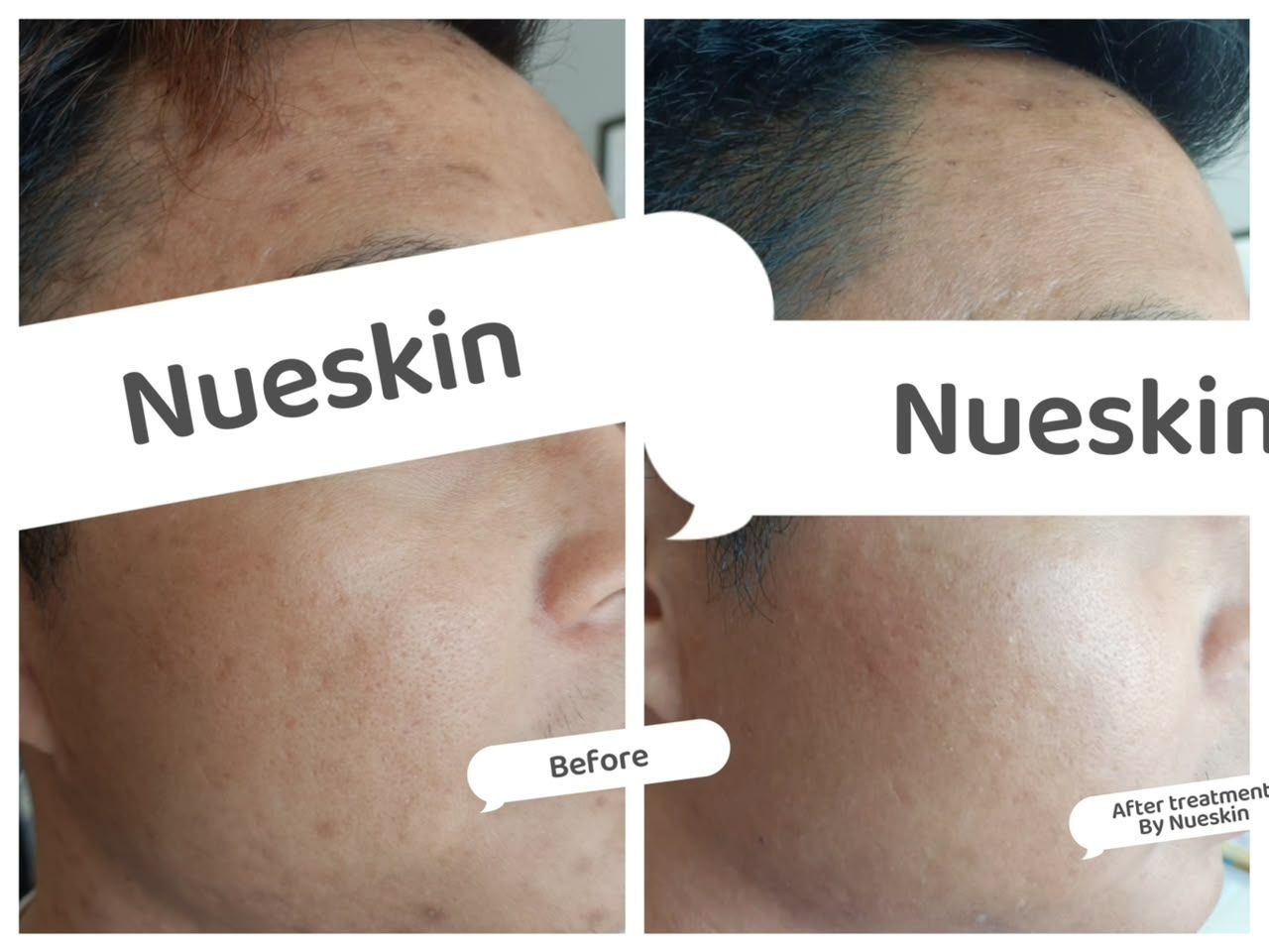 Pigment Treatment before and after — Nue Skin Beauty Esthetique