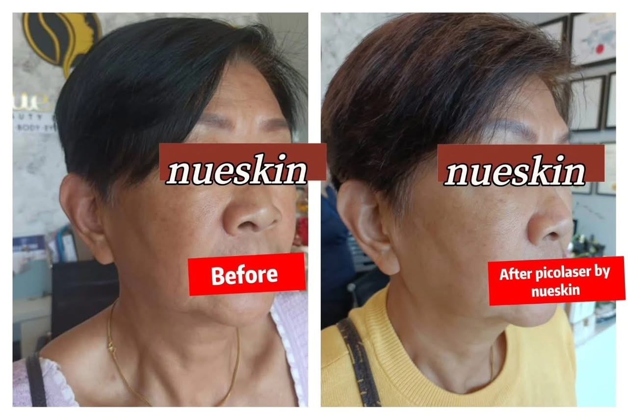 Pigment Treatment before and after — Nue Skin Beauty Esthetique