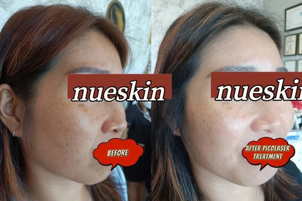 Pigment Treatment before and after — Nue Skin Beauty Esthetique