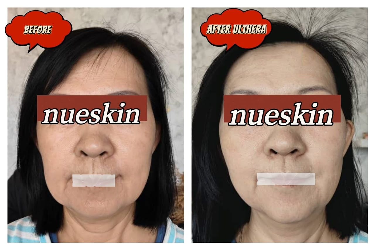 Pigment Treatment before and after — Nue Skin Beauty Esthetique