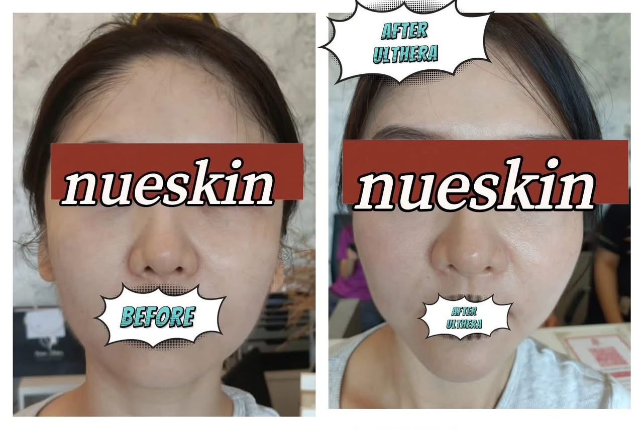 Pigment Treatment before and after — Nue Skin Beauty Esthetique