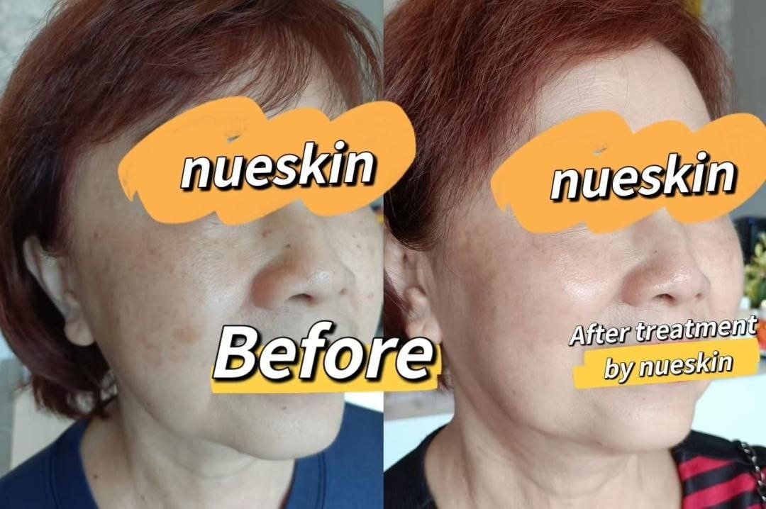 Pigment Treatment before and after — Nue Skin Beauty Esthetique
