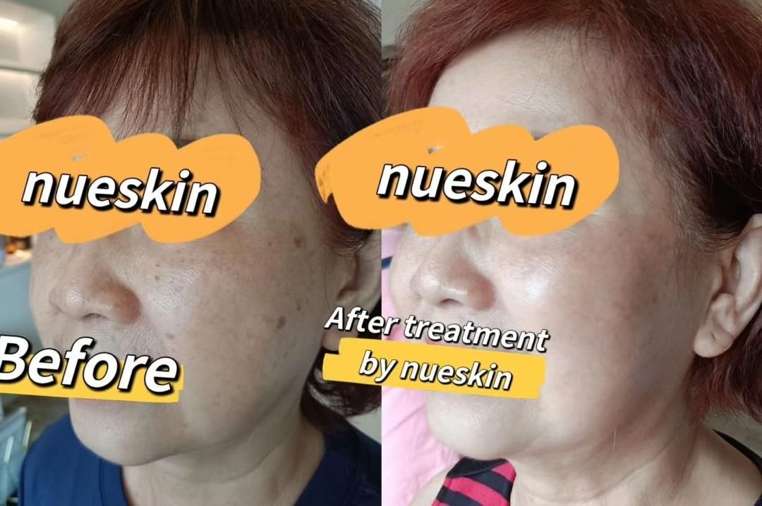 Pigment Treatment before and after — Nue Skin Beauty Esthetique