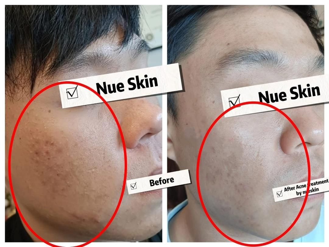 Pigment Treatment before and after — Nue Skin Beauty Esthetique