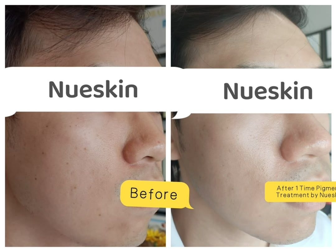 Pigment Treatment before and after — Nue Skin Beauty Esthetique