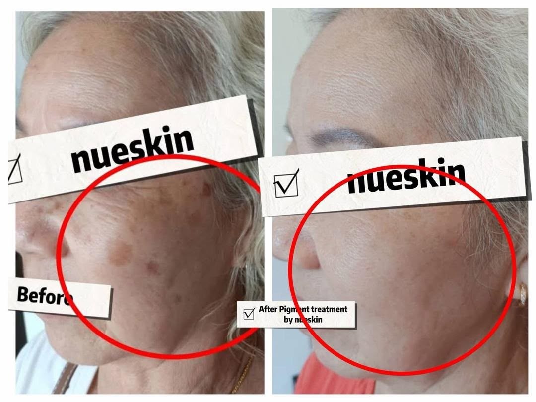 Pigmentation Treatment before and after — Nue Skin Beauty Esthetique