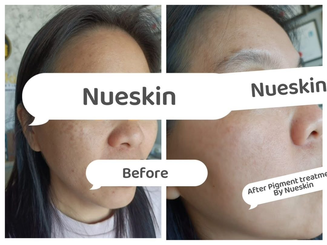 Pigmentation Treatment before and after — Nue Skin Beauty Esthetique