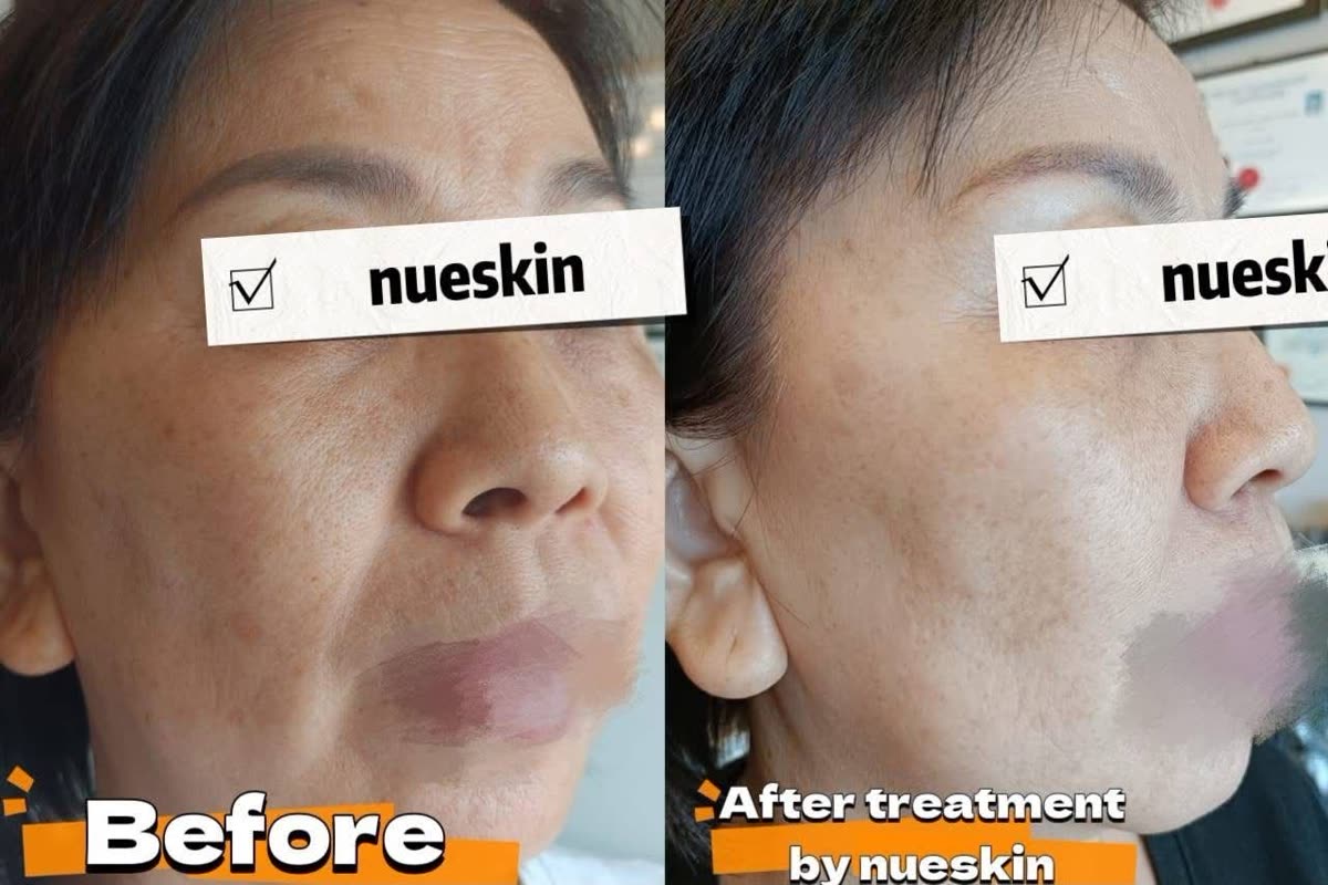 Cheek pigmentation treatment before and after — Nue Skin Beauty Esthetique