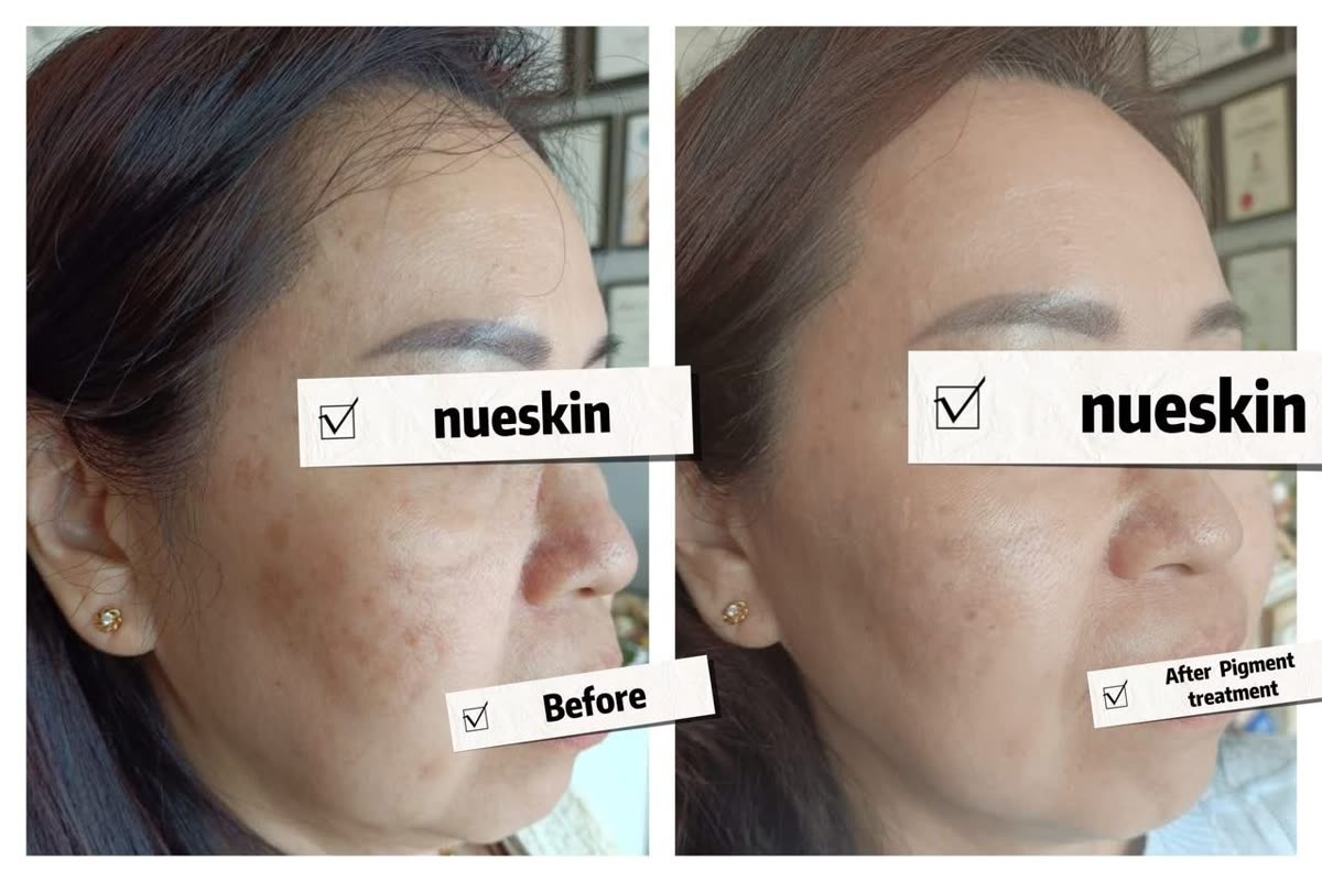 Cheek melasma pigmentation treatment before and after — Nue Skin Beauty Esthetique