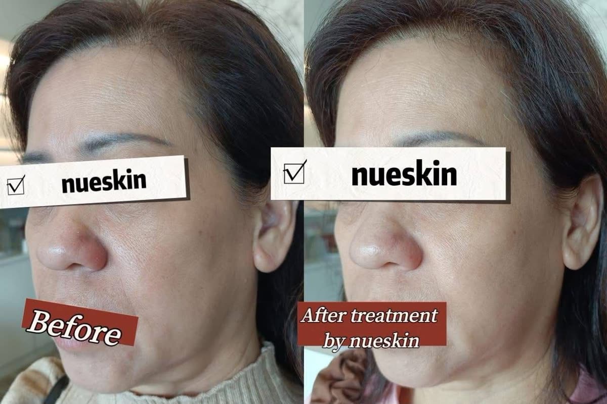 Cheek pigmentation and skin texture treatment before and after — Nue Skin Beauty Esthetique