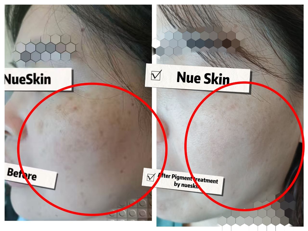 Cheek pigmentation treatment before and after — Nue Skin Beauty Esthetique